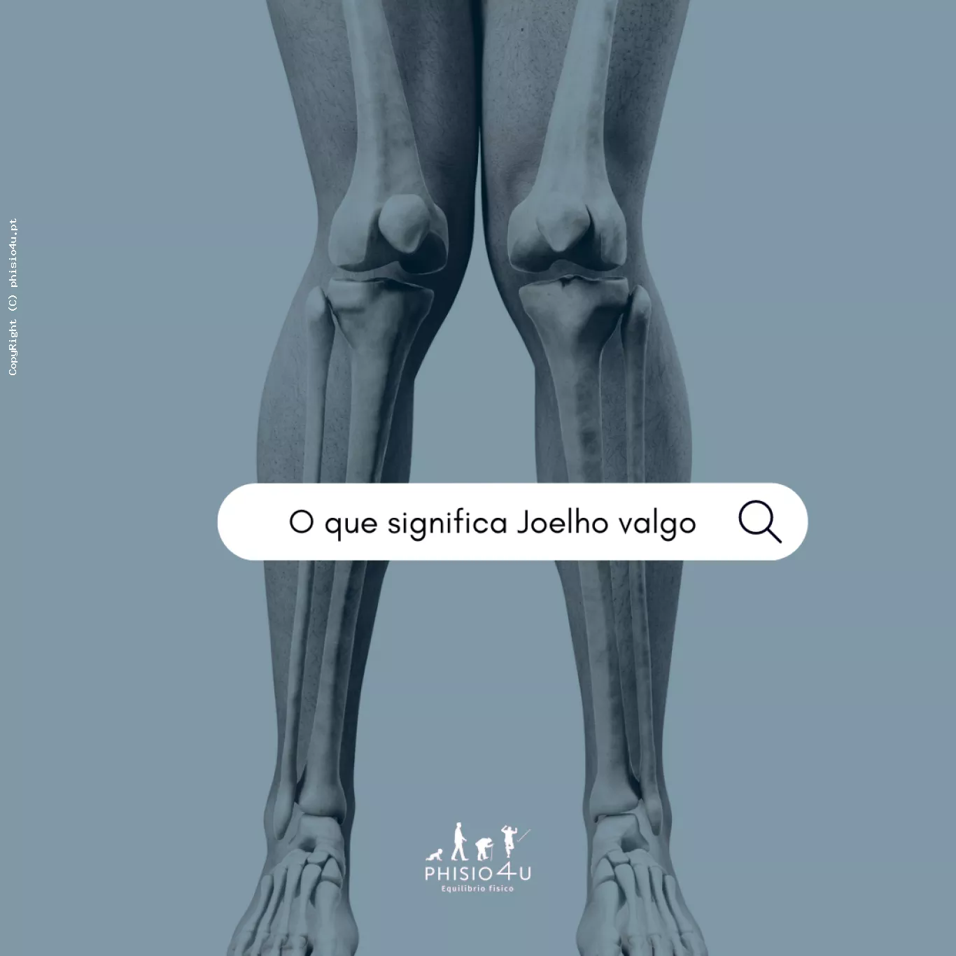 O que &eacute; Joelho Valgo?